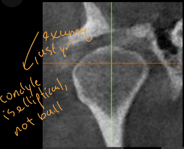 <p>What type of xray is best for visualizing TMJ (what was this taken with), how would you describe this xray</p>