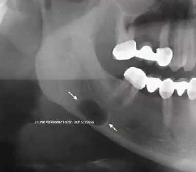 <p>how would you describe the border of this lesion </p>