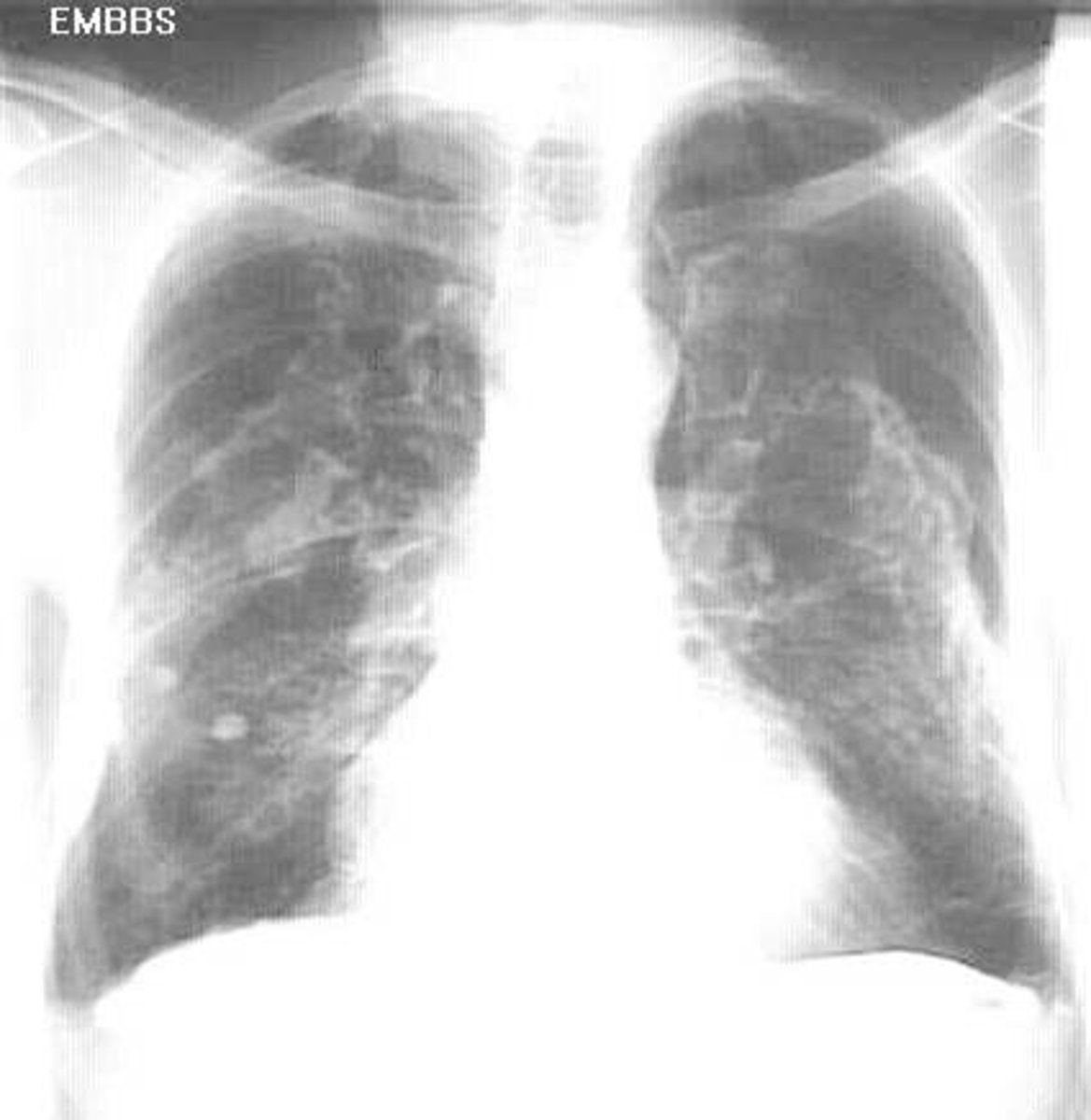 <p>Cancer of the tissue that covers many internal organs, including the lungs</p><p>Takes decades to develop.</p>