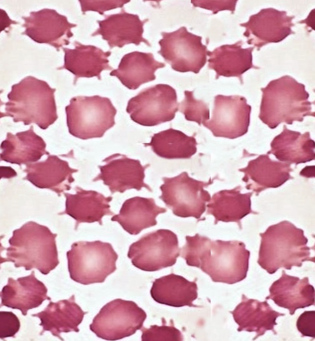 <p>What type of smear cell and what conditions is it seen in</p>