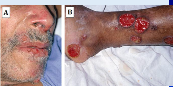 <ol><li><p>Cutaneous lesions extending directly to adjacent mucuos membranes</p></li><li><p>Metastasis of cutaneous lesions via lymphatic or haematagonous spread to mucosal layer of mouth and upper respiratory tract</p></li></ol><p></p>