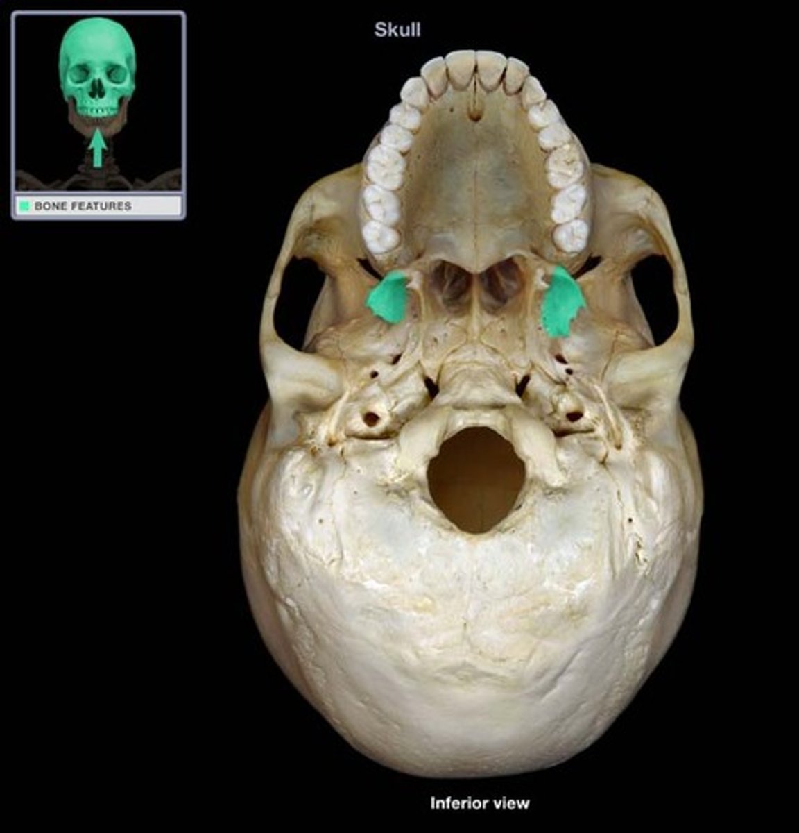 <p>arises at junction of greater wing and body of the sphenoid, only seen on inferior surface of skull</p>