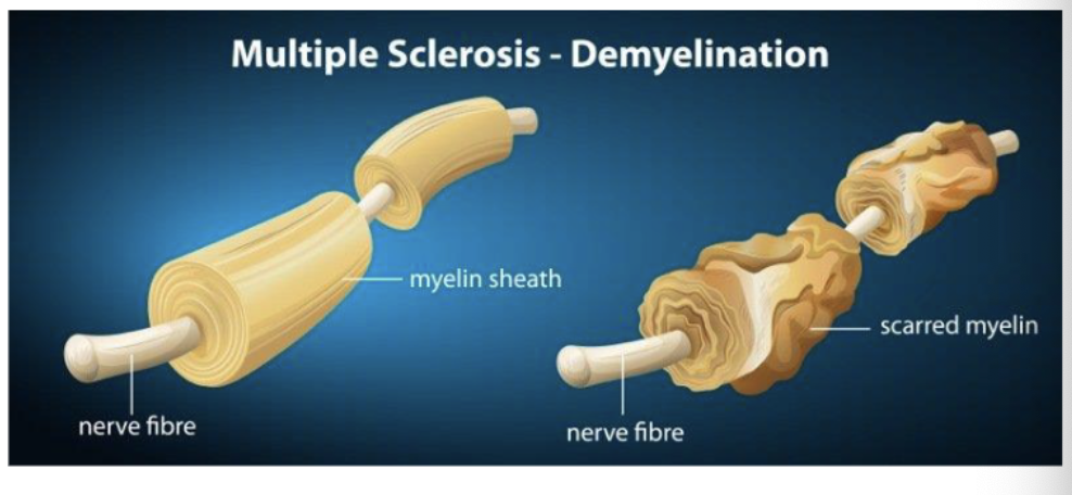 <p><span>In multiple sclerosis, the immune system destroys the myelin sheets of neurons. Many sensory and motor functions are impaired.</span></p>