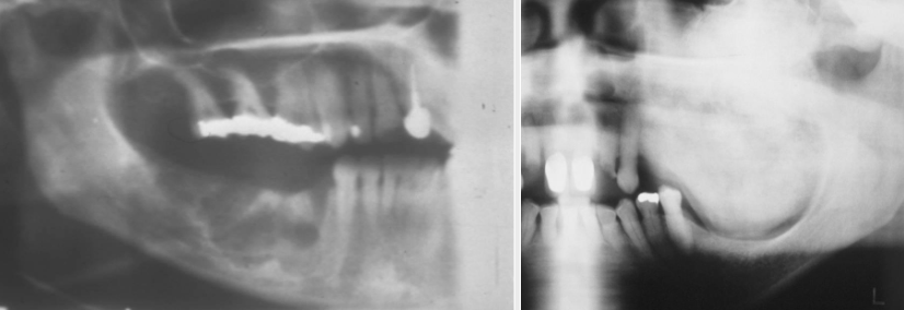 <p>Borders that are not well defined, making it difficult to detect the exact parameters of the lesion; this may make treatment more difficult and, depending on the biopsy results, more radical</p>