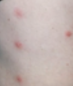 <p>Configuration of Skin Lesion</p><ul><li><p>Skin lesions are <strong>isolated</strong> with <strong>no pattern</strong></p></li></ul><p></p>