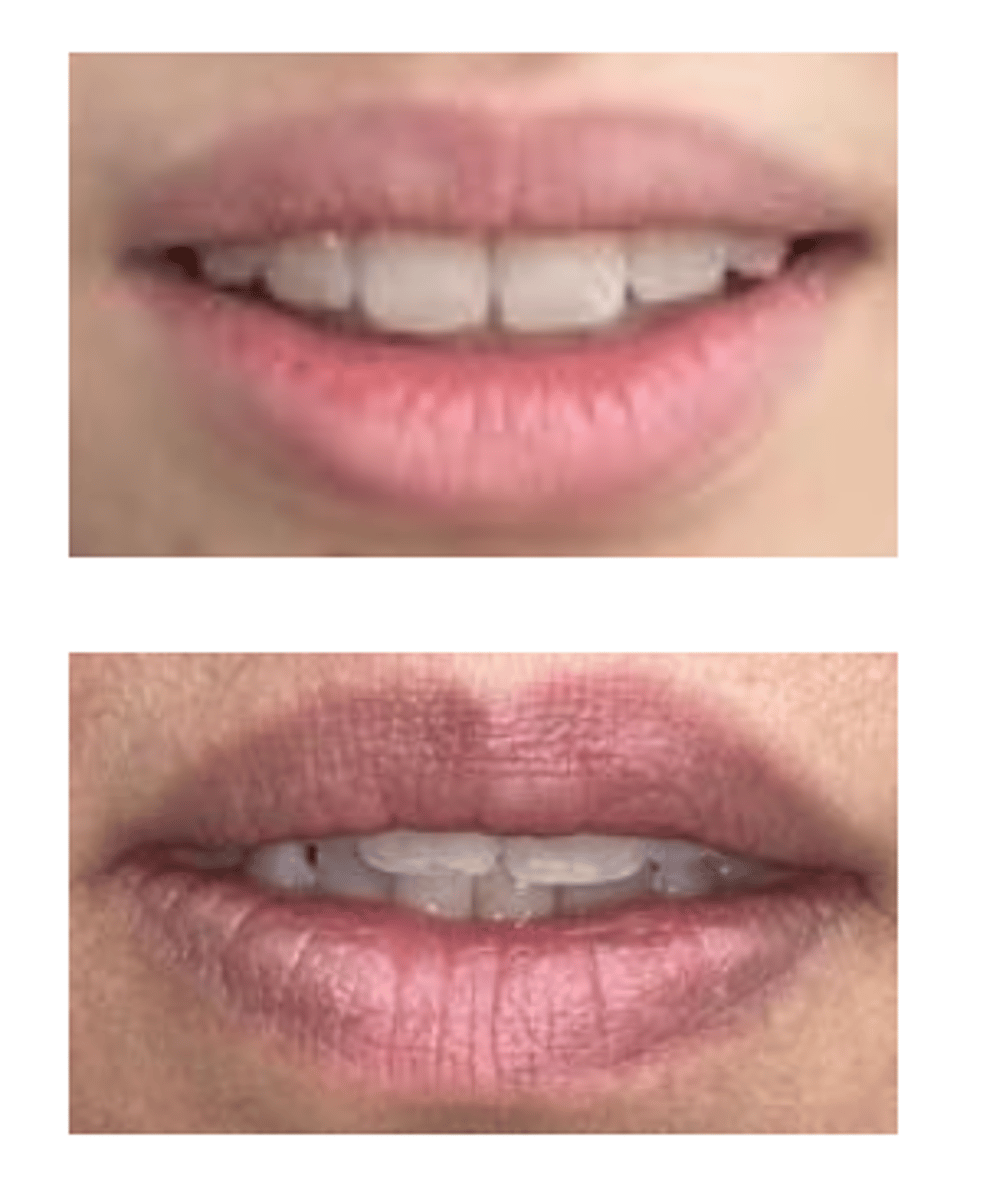 <p>incisal edge position</p>