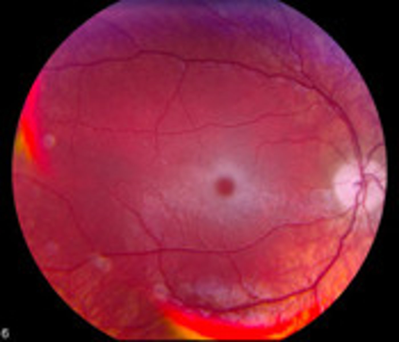 <p>Tay-Sachs (ganglioside accumulation - NO hepatosplenomegaly)</p><p>Niemann-Pick (sphingomyelin accumulation w/ hepatosplenomegaly)</p><p>Central retinal artery occlusion</p>