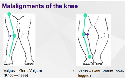 <p>Valgus = knees come in together</p><p>Varus = knees are apart</p>