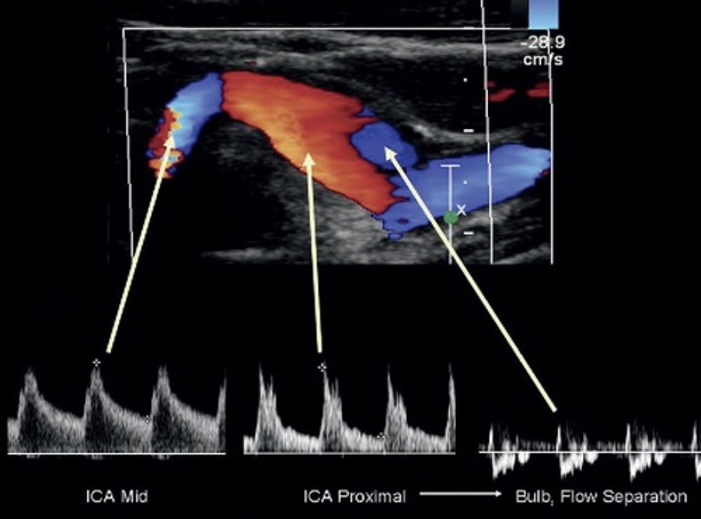 <p>Normal to have turbulent flow at separation/divider</p>