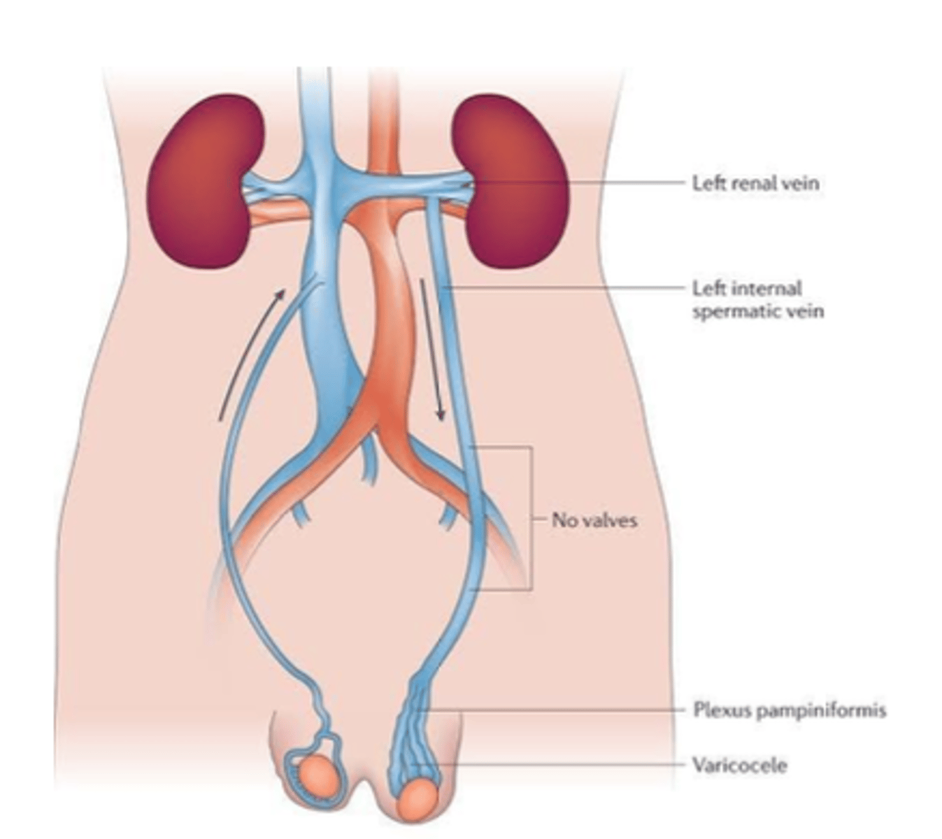 <p>Porque requiere tiempo para que el tumor invada la vena renal y cause congestión venosa.</p>