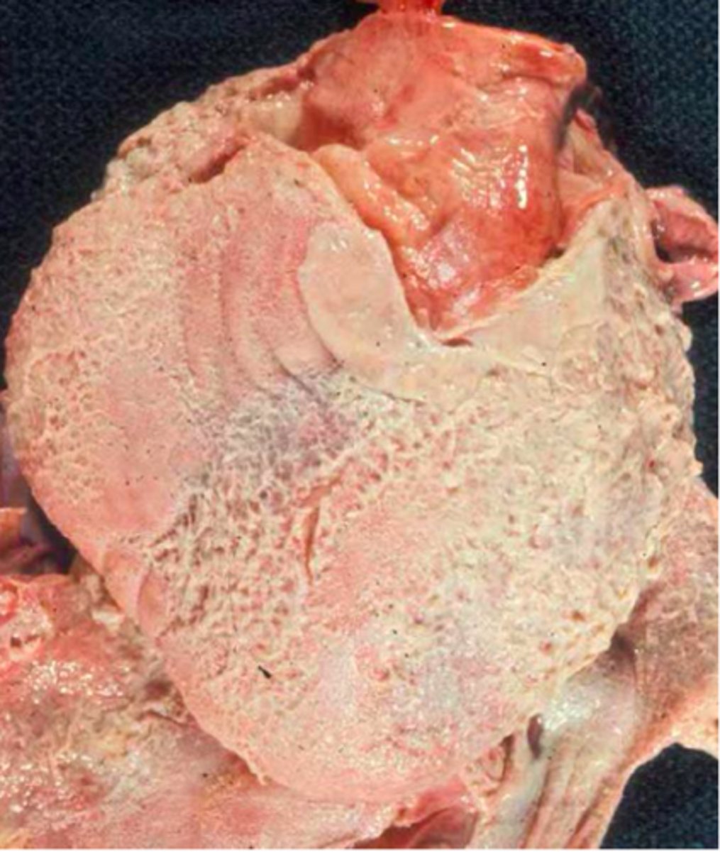 <p>acute inflammation of the pericardium</p>