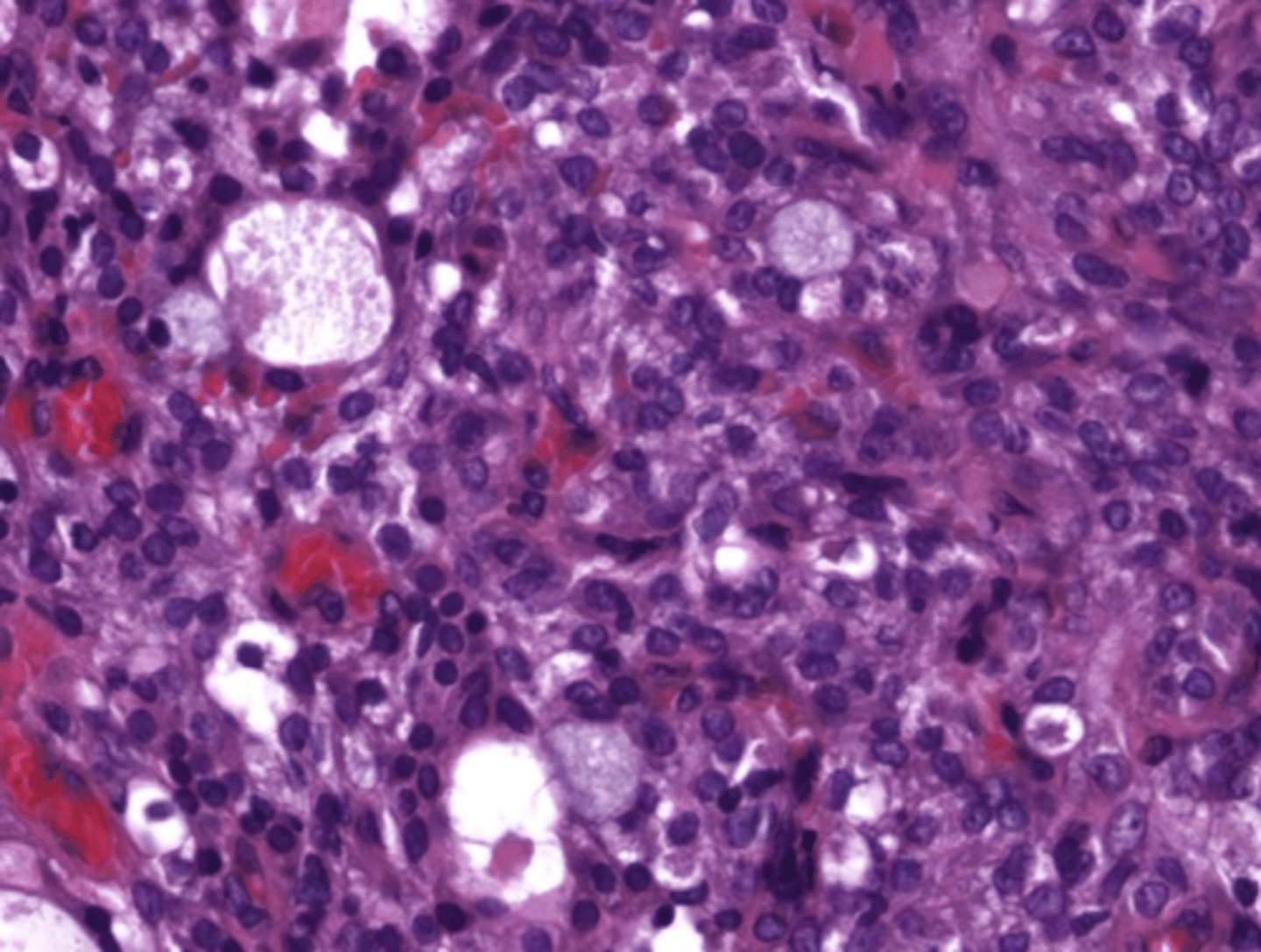 <p>These histologic characteristics are indicative of what oral pathology?</p><p>Epidermoid cells</p><p>Mucous cell</p><p>Ductal structures</p><p>Cystic spaces</p>