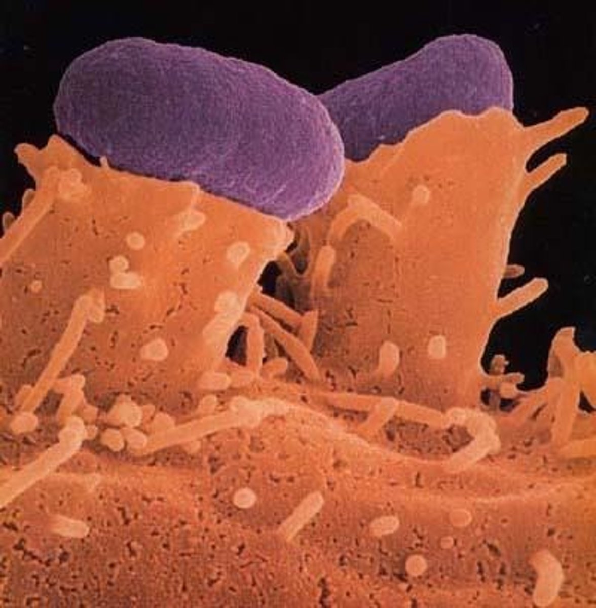 <p>Identify Pathogen causing Diarrhea:</p><p>Gram-negative rod</p><p>-Hx:</p><p>&gt; Children</p><p>-Path: Adheres to apical surface --&gt; flattens/blunts villi --&gt; less absorption</p><p>-Sx/PE:</p><p>&gt; Watery (Non-Inflammatory) Diarrhea</p><p>-Dx:</p><p>(+) Lactose</p>