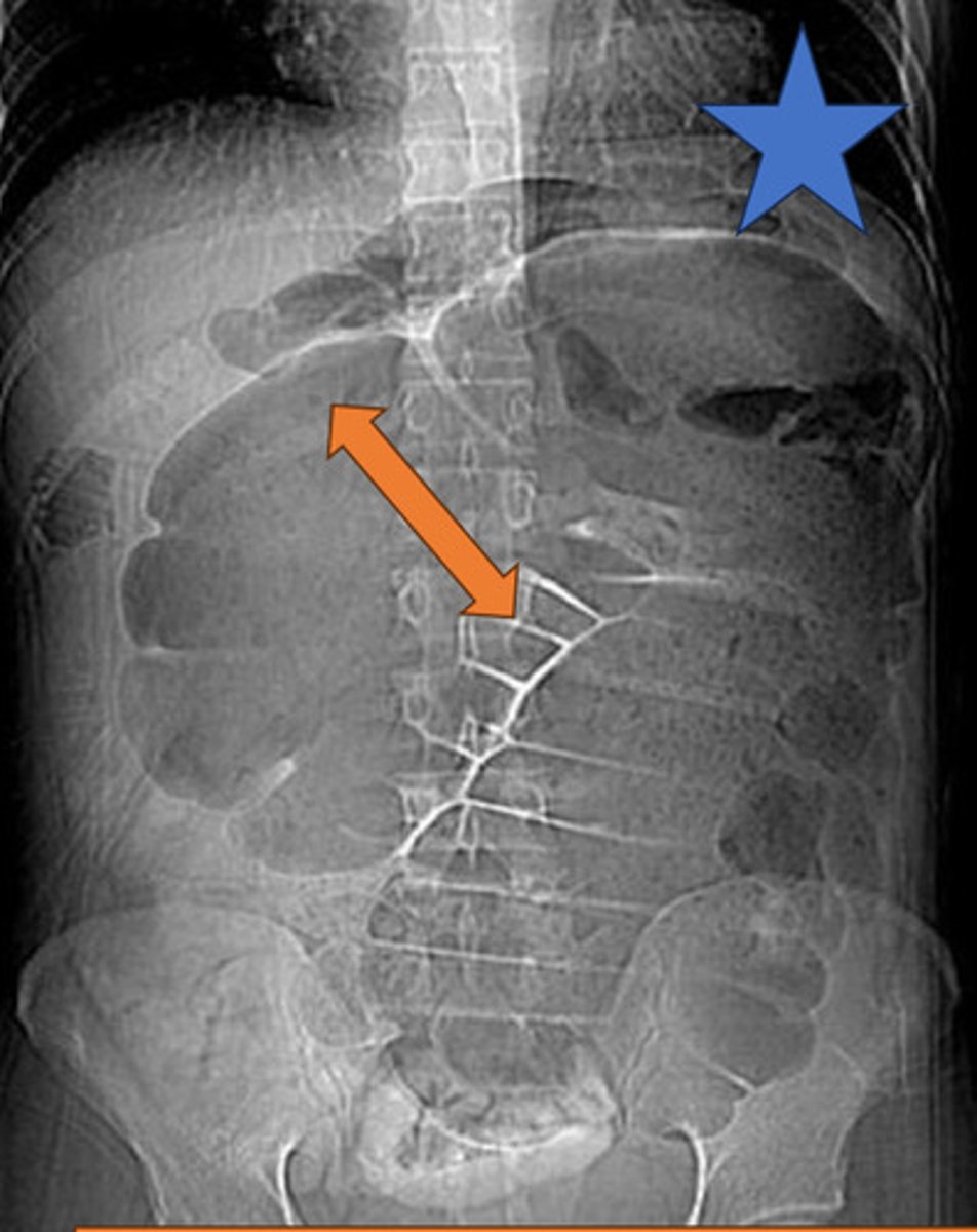 <p>dilated cecum takes on mammalian embryo shape</p>