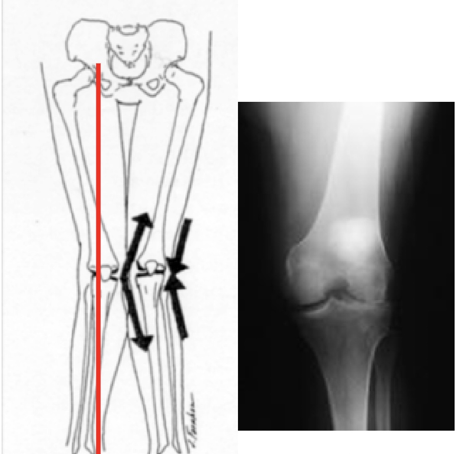 <p>What is the static alignment of this knee?</p>