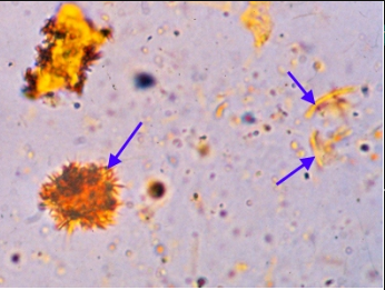 <p>The yellow clumped needles or granule-like crystals that are indicated by the arrows in the image are:</p><p>Bilirubin crystals</p><p>Leucine crystals</p><p>Cystine crystals</p><p>Cholesterol crystals</p>