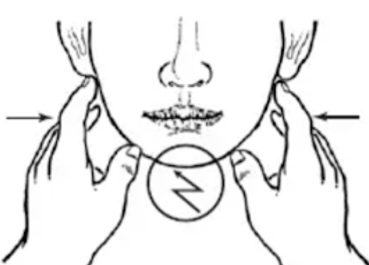 <p>Pression latérale réveille une douleur symphysaire</p>