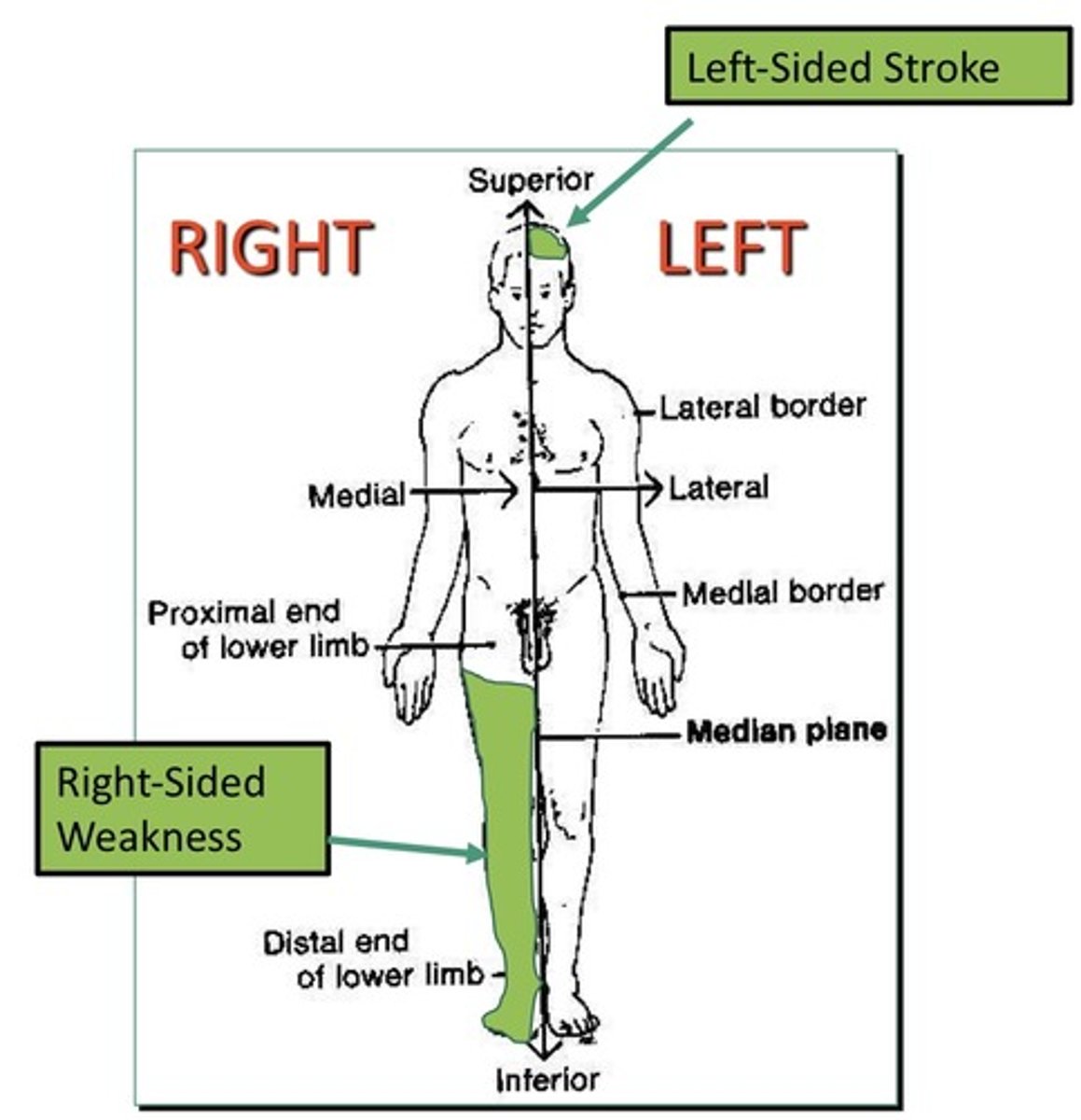 <p>1. Refers to the lesion and deficit on the opposite side of the body</p><p>2. Can describe the relationship between the right eye and left ear</p><p>3. Refers to two things on the opposite side of the body</p>