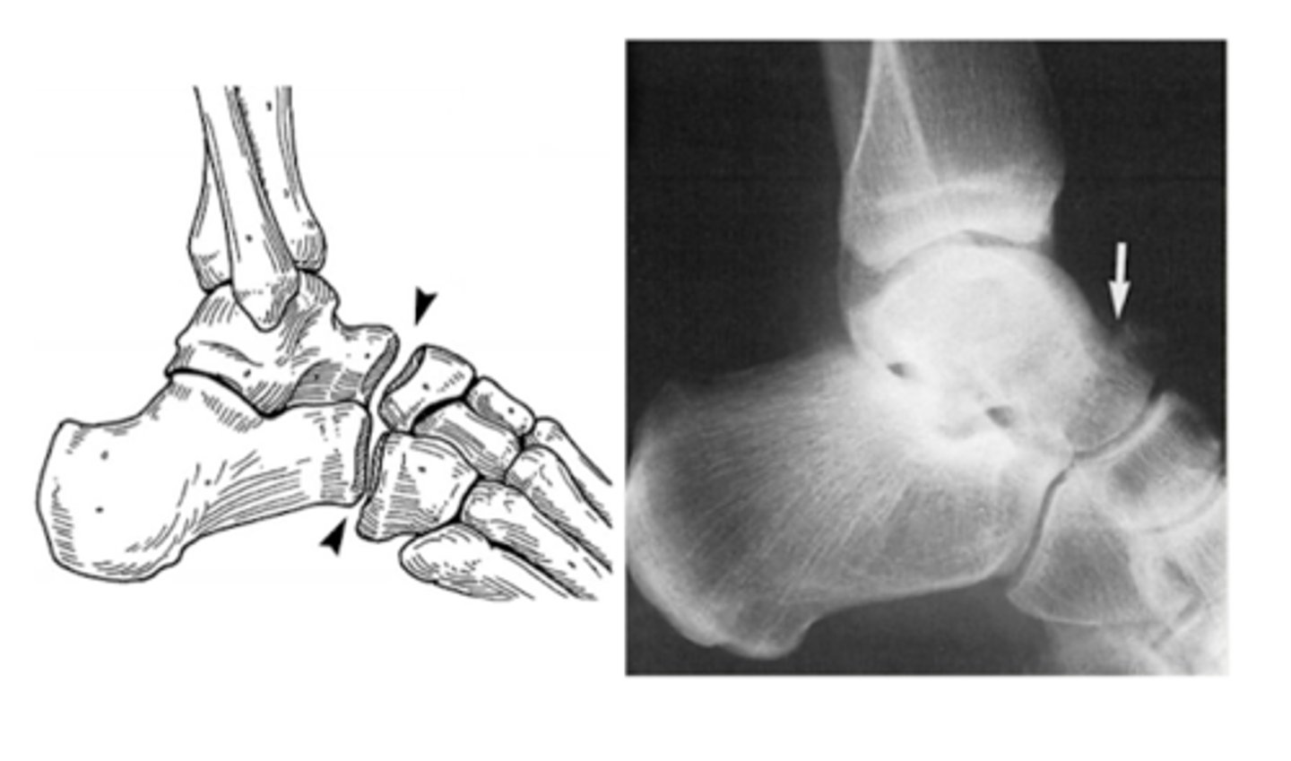 <p>Dislocation of the mid-tarsal joints (talonavicular + calcaneocuboid)</p><p>Fracture of the calcaneus, cuboid and navicular</p>
