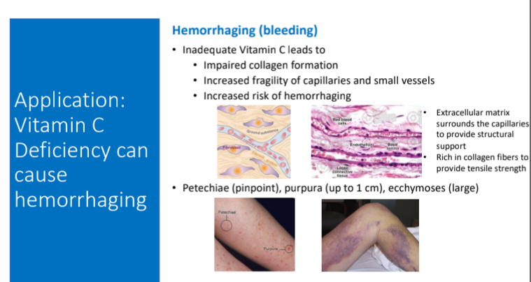 <ol><li><p>Impaired collagen formation </p></li><li><p>Increased fragility of capillaries and small vessels</p><p>^Increased risk of hemorrhaging </p></li></ol><p></p>