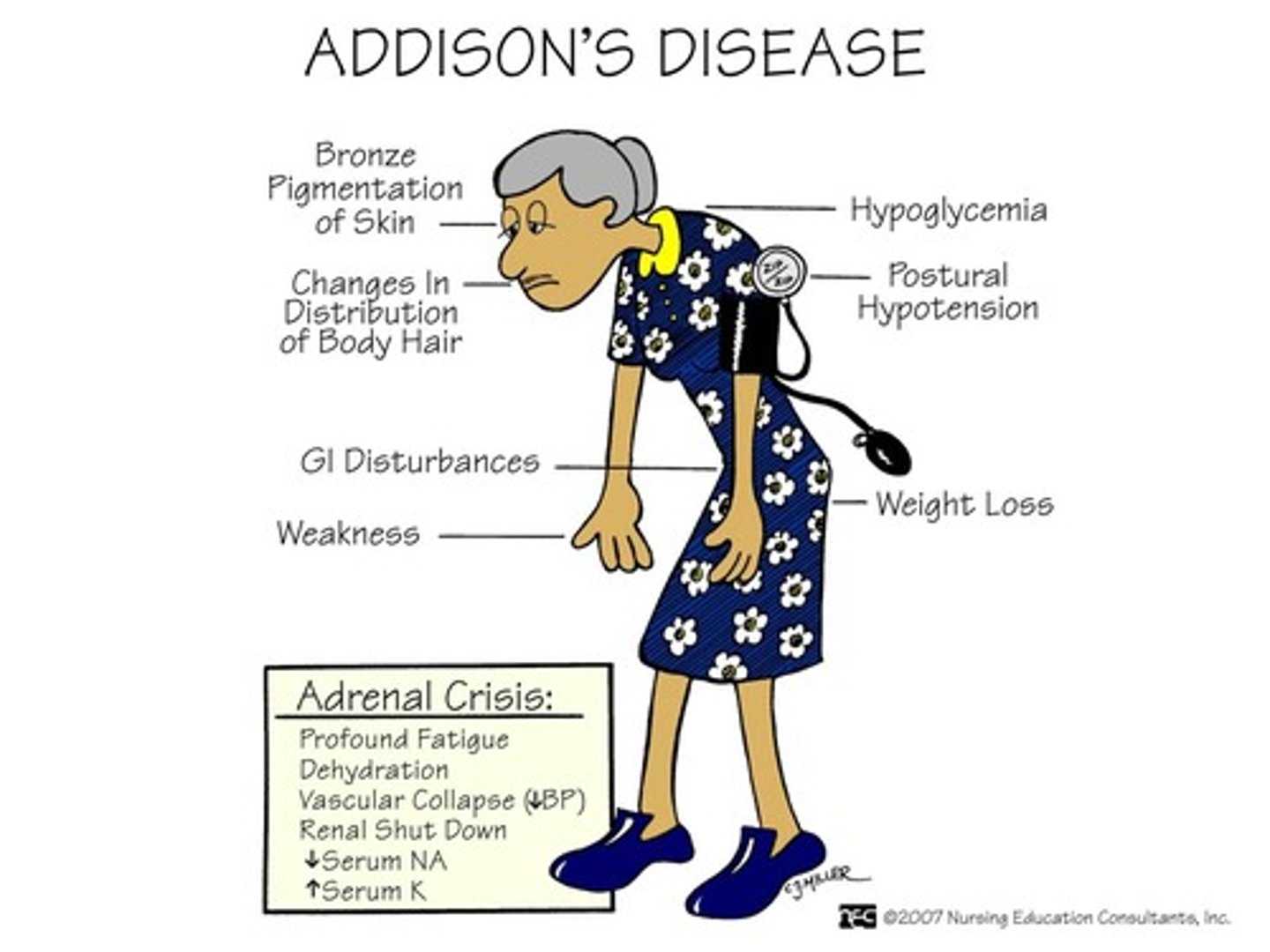 <p>occurs when the adrenal glands do not produce enough of the hormones cortisol or aldosterone</p><p>aldosterone knocked out:</p><p>- low salt and water---> low BP</p><p>- increased potassium--->hyperkalemia</p><p>cortisol knocked out:</p><p>- increased ACTH---> increased melanin production (bronze skin, hyperpigmentation)</p><p>androgens knocked out:</p><p>- decreased libido</p><p>- low sex drive</p><p>- erectile dysfunction</p><p>- infertility</p><p>nursing considerations</p><p>- monitor Na and H20</p><p>- monitor fluid volume</p><p>- give them cortisol</p><p>- give them estrogen and testosterone (these thicken the blood and makes person hyper-coagulable, monitor for clots to prevent DVTs and PE)</p><p>increased estrogen caused by:</p><p>- birth control</p><p>- obesity</p><p>- patient taking tamoxifin</p>