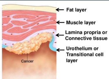 <ol><li><p>transitional epithellium</p></li></ol><ul><li><p>in contact with urine</p></li></ul><ol start="2"><li><p>lamina propria</p></li></ol><ul><li><p>a layer of connective tissue and blood vessels</p></li></ul><ol start="3"><li><p>detrusor muscle</p></li></ol><ul><li><p>deep muscle layer made of thick smooth musle to form the wall of the bladder</p></li></ul><ol start="4"><li><p>perivascular fat</p></li></ol><ul><li><p>outer most layer: fat, fibrous tissue, and blood vessels</p></li></ul><p></p>