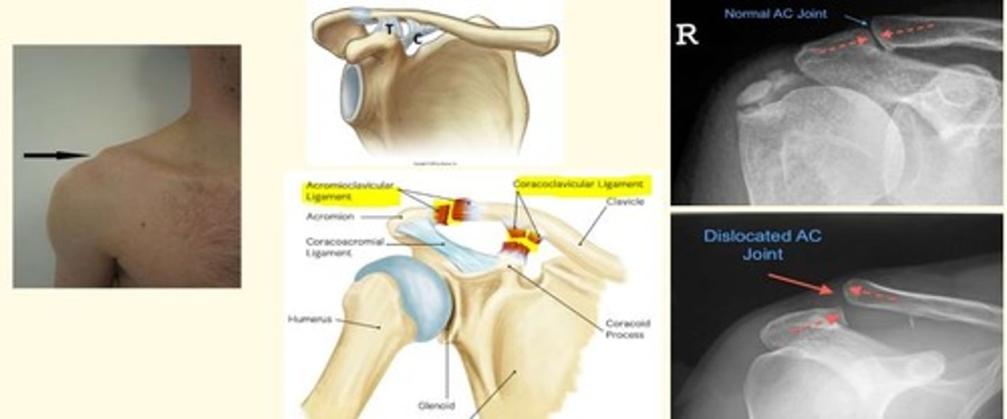 <p>Acromioclavicular (AC) joint dislocation can lead to rupture of the coracoclavicular ligaments</p>