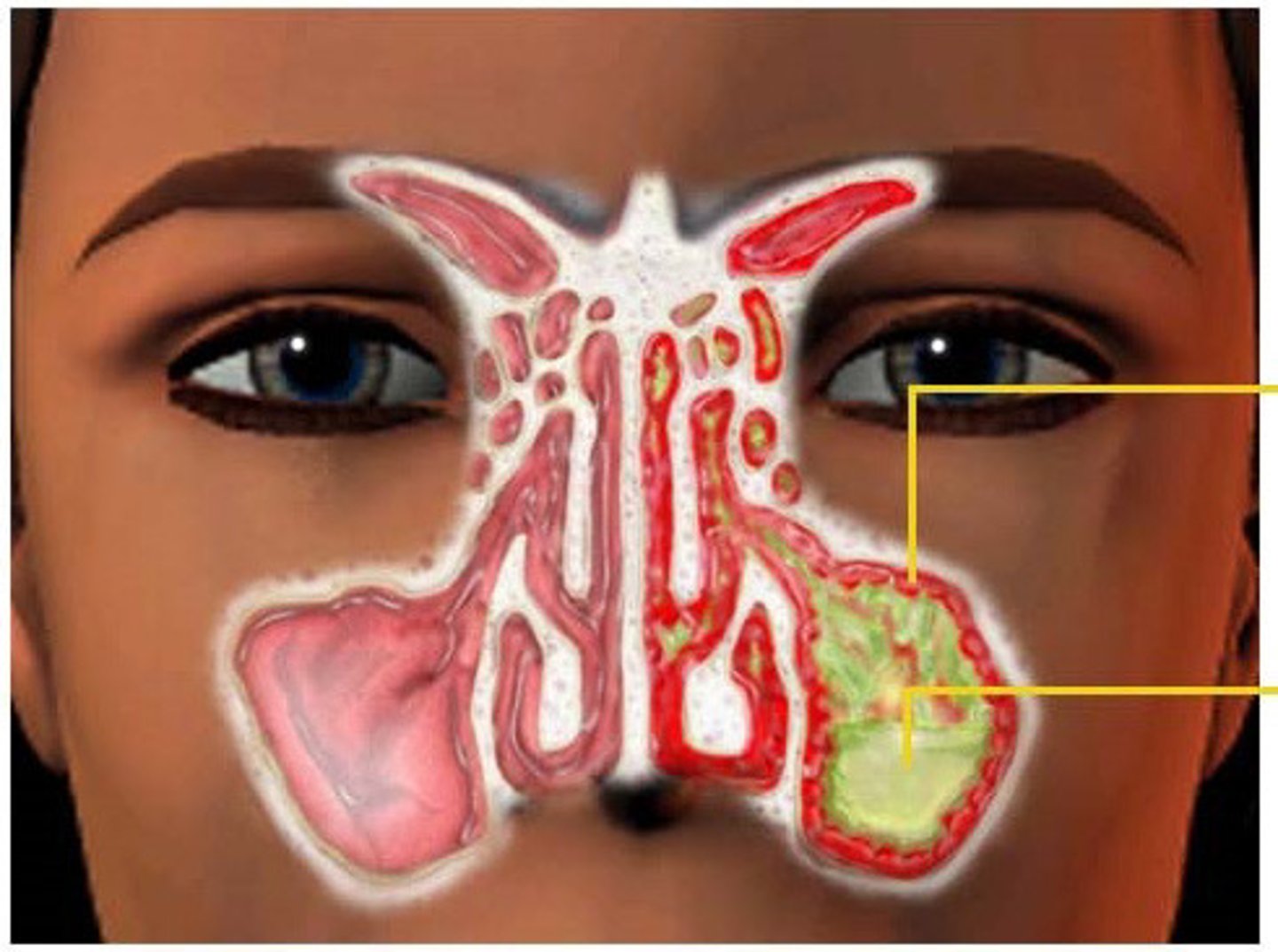 <p>Inflammation of the sinuses due to allergy or bacterial invasion.</p>