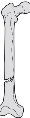 <p><span>what type of fracture completeness is this?</span></p>