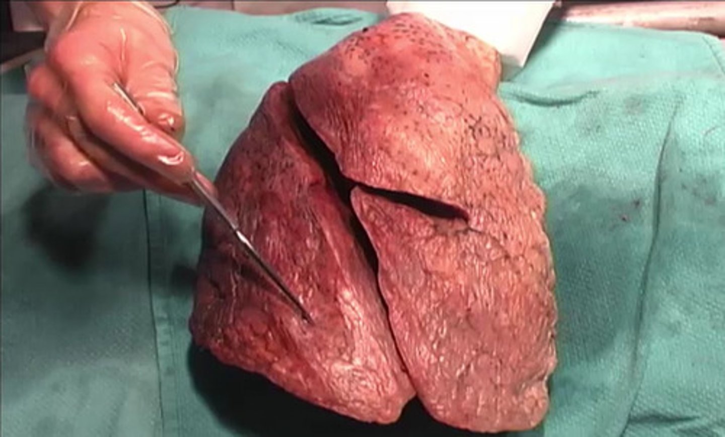 <p>Which lobe is this?</p><p>Medial</p><p>Inferior</p><p>Distal</p><p>Exterior</p>