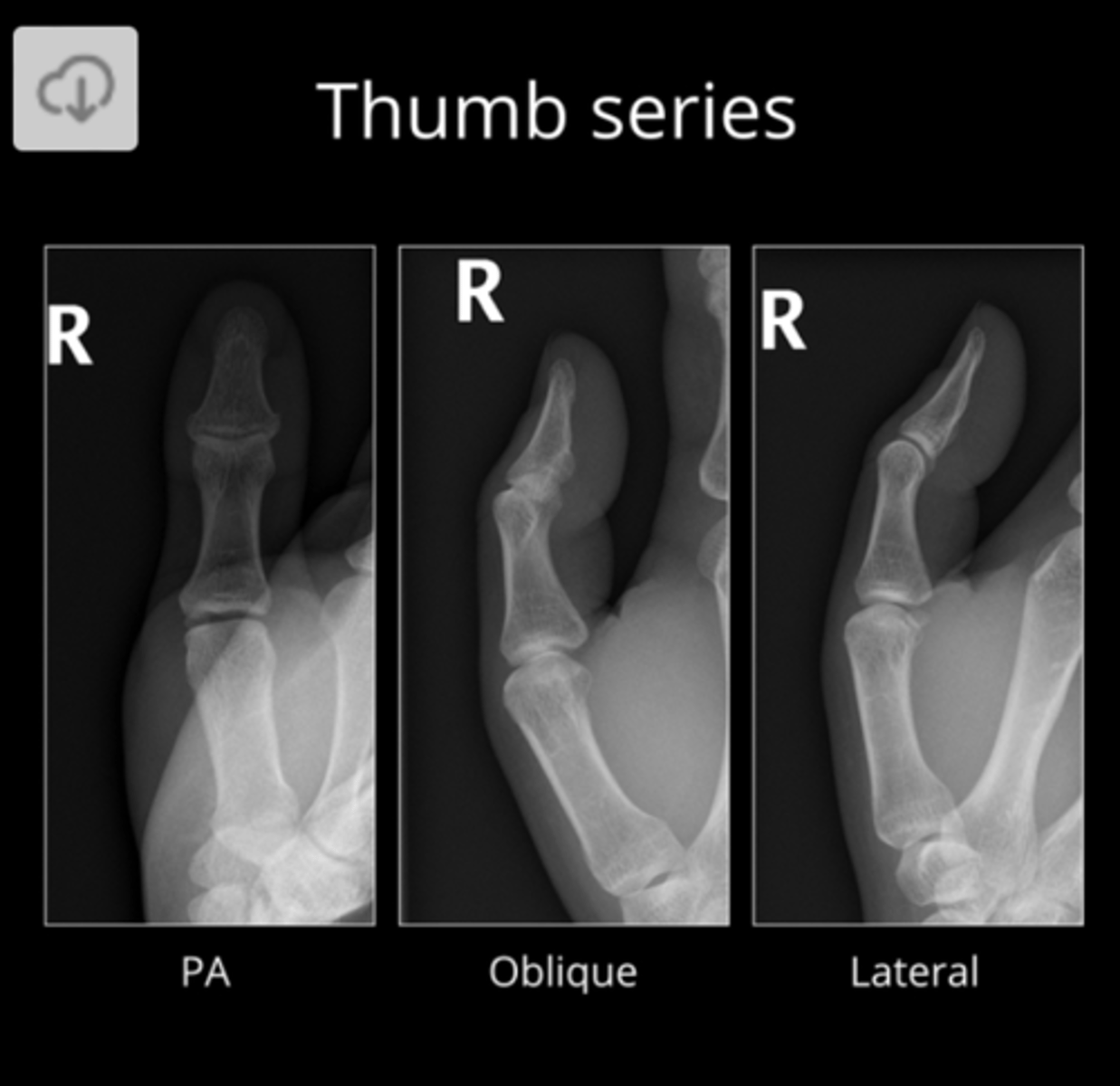 <p>The first finger or thumb requires specific positioning (tilted) for its radiographic projections due to its different orientation from the rest of the fingers.</p>