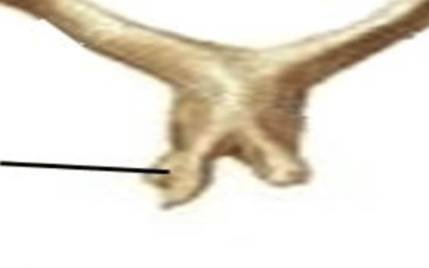 <p>bifid spinous process</p>