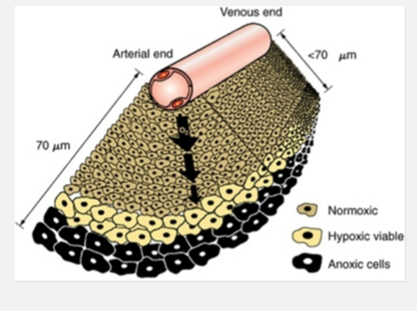 <p>Centers of large tumors tend to be chronically hypoxic/anoxic due to distance from capillary beds</p><p>Cells between oxygenated and anoxic layer may be hypoxic enough to be radioresistant but oxygenated enough to promote tumor growth</p>