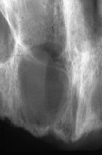 <p>Residual Cyst</p>