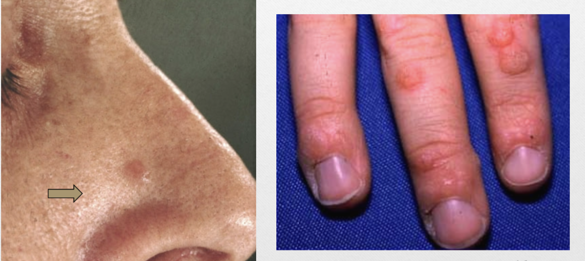 <p>ex. wart (verruca vulgaris)</p>