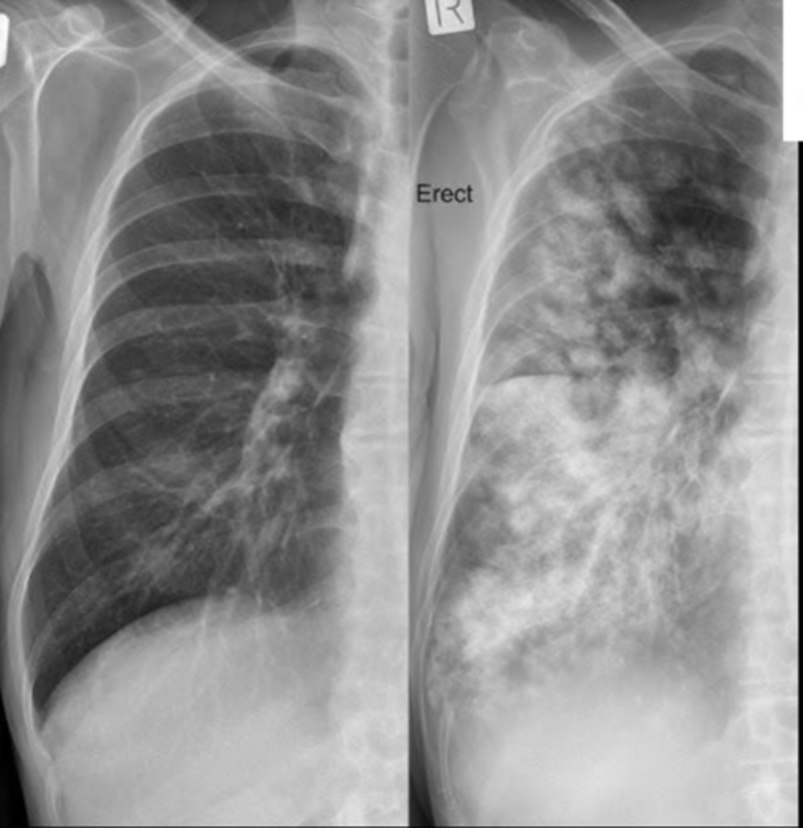 <p>What abnormal sign is seen here?</p>