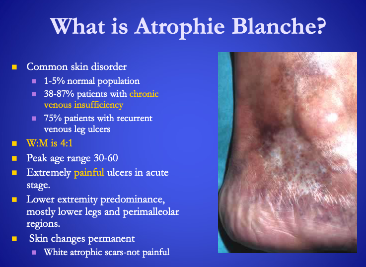 <p>Atrophie Blanche</p><ul><li><p>Common skin disorder<br></p><ul><li><p>1-5% normal population</p></li><li><p>38-87% patients with <span><strong>[...]</strong></span></p></li><li><p>75% patients with recurrent venous leg ulcers&nbsp;</p></li></ul></li><li><p>More frequent in <span>women</span> (4:1 Ratio)</p></li><li><p>Extremely painful ulcers in acute stage</p></li><li><p><strong>mostly lower legs and perimalleolar regions.&nbsp;<br></strong></p></li><li><p>Skin changes permanent<br></p><ul><li><p>White atrophic scars-not painful&nbsp;</p></li></ul></li></ul><p></p>