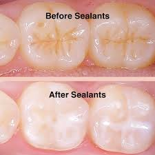 <p>Thin protective coatings placed on the chewing surfaces of back teeth to prevent cavities.</p>