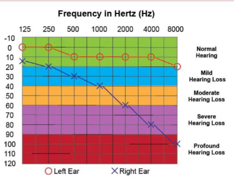 <p>Explain the results of this audiogram?</p>