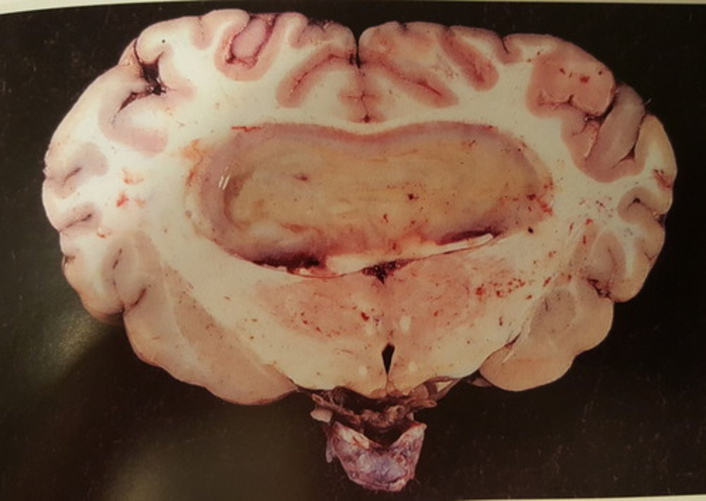 <p>Hjerne fra okse. Patoanatomisk diagnose?</p>