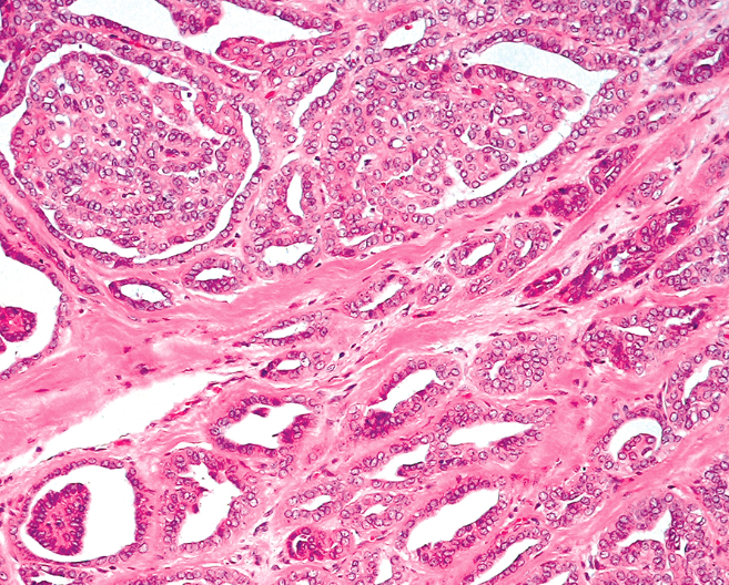 <p>Femme de 60 ans avec tumeur du palais </p><p>1) Diagnostic</p><p>2) Epidémio (localisation, sex prédominant)</p><p>3) Histo</p><p>4) IHC</p><p>5) Moléculaire</p>