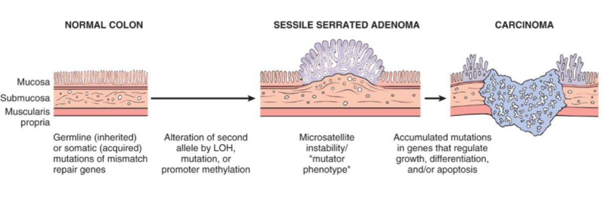 <p>functional defect in mismatch repair genes; accounts for 15% of sporadic colorectal carcinoma. </p><p>caused by aberrant MMR genes — leads to microsatellites which are prone to mutations</p><p>this is a common mechanism of colorectal carcinoma arising in patients with Lynch Syndrome. </p>