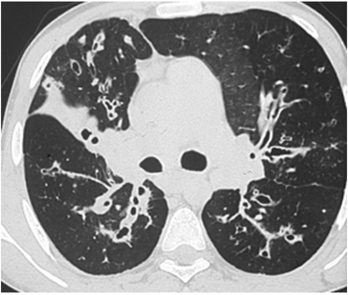 <p>What is the imaging of choice for CF?</p>