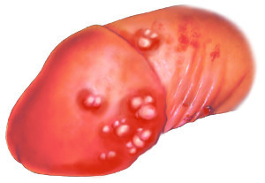 <p>Herpes Genitalis</p>