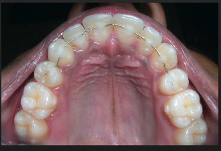 <p>SRP, splinting for patient comfort</p>