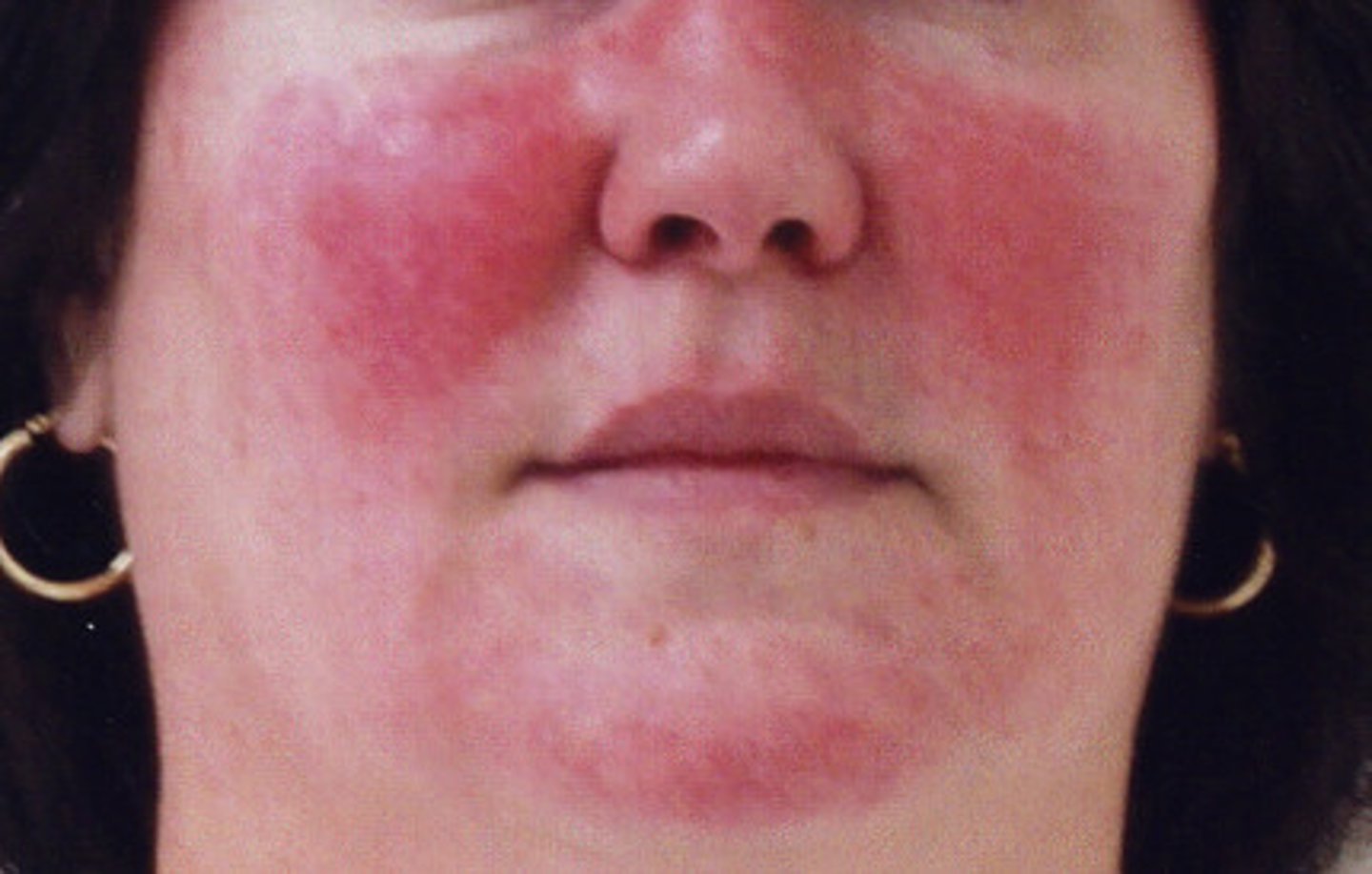 <p>Forehead, nose, upper cheeks, chin.</p><p>Most often <strong>symmetric</strong> presentation</p>