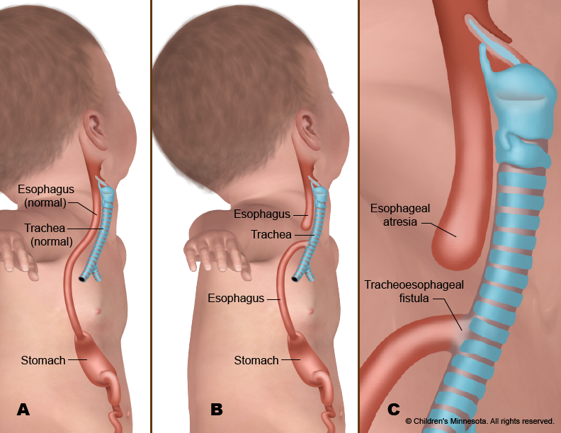 <p>A congenital disorder in which the esophagus does not properly form during pregnancy. Symptoms include coughing, choking, and turning blue when feeding (from lack of oxygen).</p>