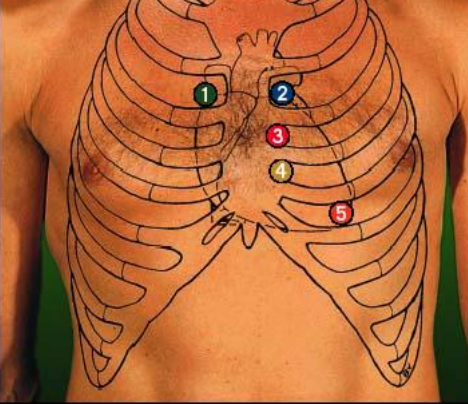 sternal margin of R 2nd intercostal 

number 1