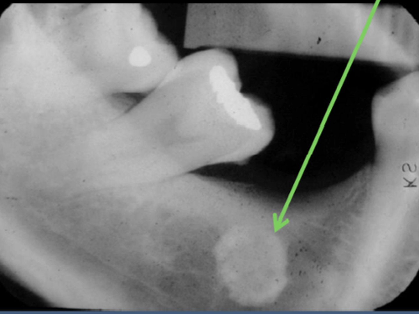 <p>white or light grey on a image due to x-ray not being able to penetrate it</p>