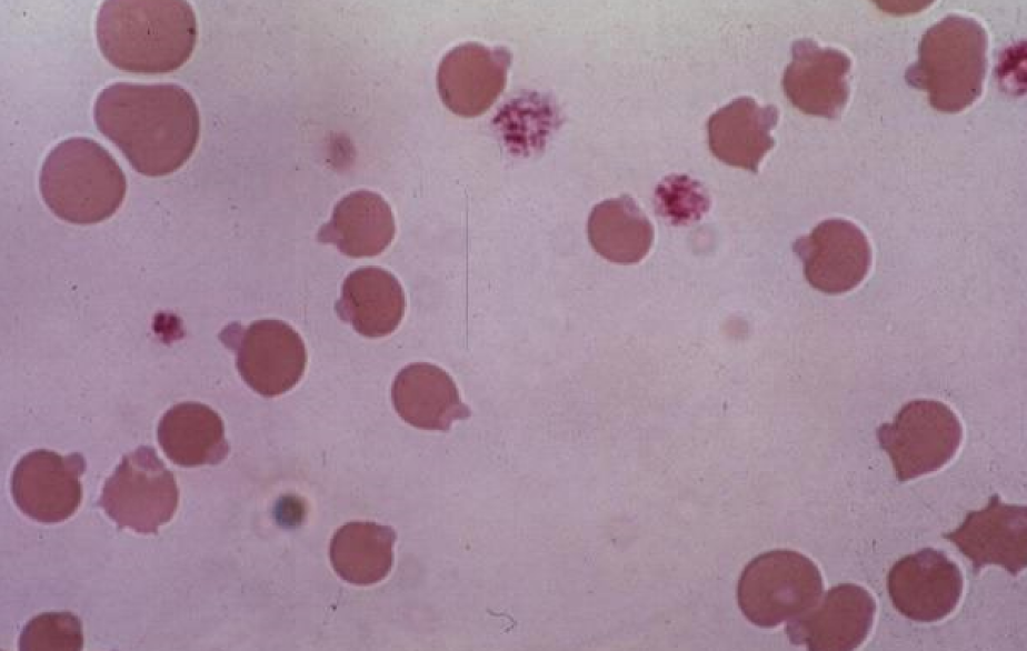 * denatured & precipitated Hb
* Caused by oxidative damage
* Stain light red w Romanowsky stains
* Stain blue w NMB stain
* Up to 5% of the RBCs in nx cats
* causes: Onion, Kale (RUMs), Winter rye (cattle), Red maple leaves (horses) , Copper toxicity (sheep, goats), Zinc (dogs, eating pennies), Acetaminophen (cats), Methylene blue (cats, dogs), Methionine (cats), Phenazopyridine (cats), Vitamin K3 (dogs), Phenothiazine (horses), Crude oil (marine birds), DM, Lymphoma, Hyperthyroidism (cats)